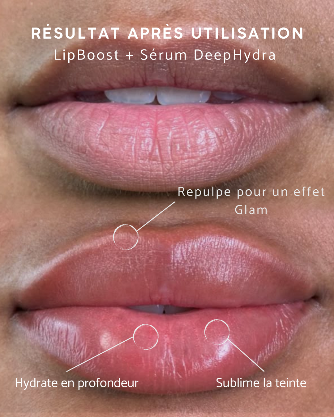LipBoost DAZ®